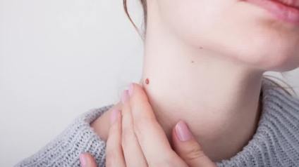 How to Rid Skin Tags and Warts Overnight &ndash; Dr. Berg Explains