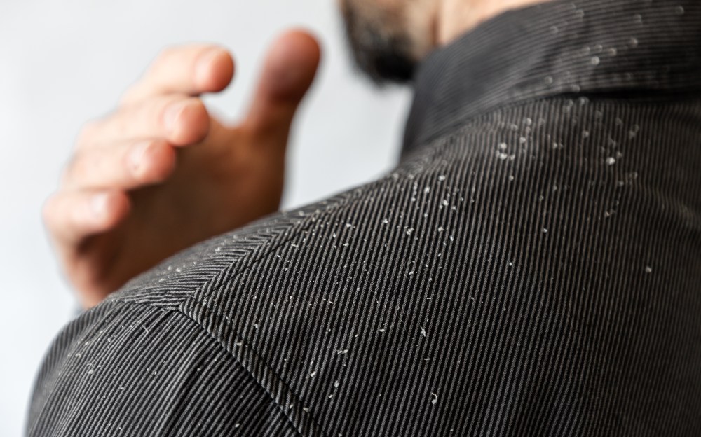 4 Remedies for Dandruff You Can Try at Home