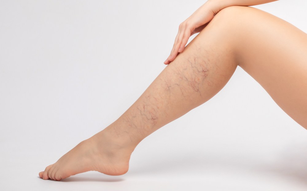 5 Spider Vein Natural Remedies