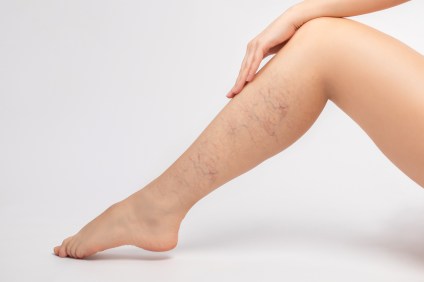 5 Spider Vein Natural Remedies
