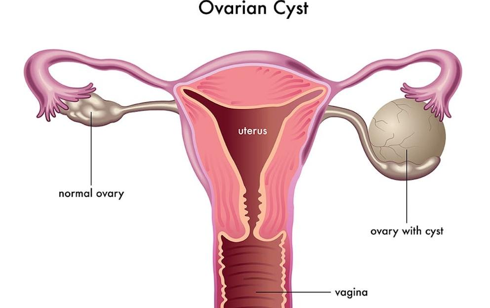 Fix Ovarian Cysts and Fibrocystic Breast with One Mineral
