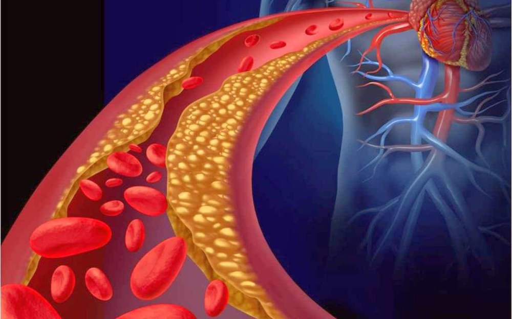 Reversing Atherosclerosis or Hardening of the Arteries