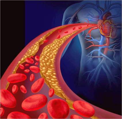 Reversing Atherosclerosis or Hardening of the Arteries