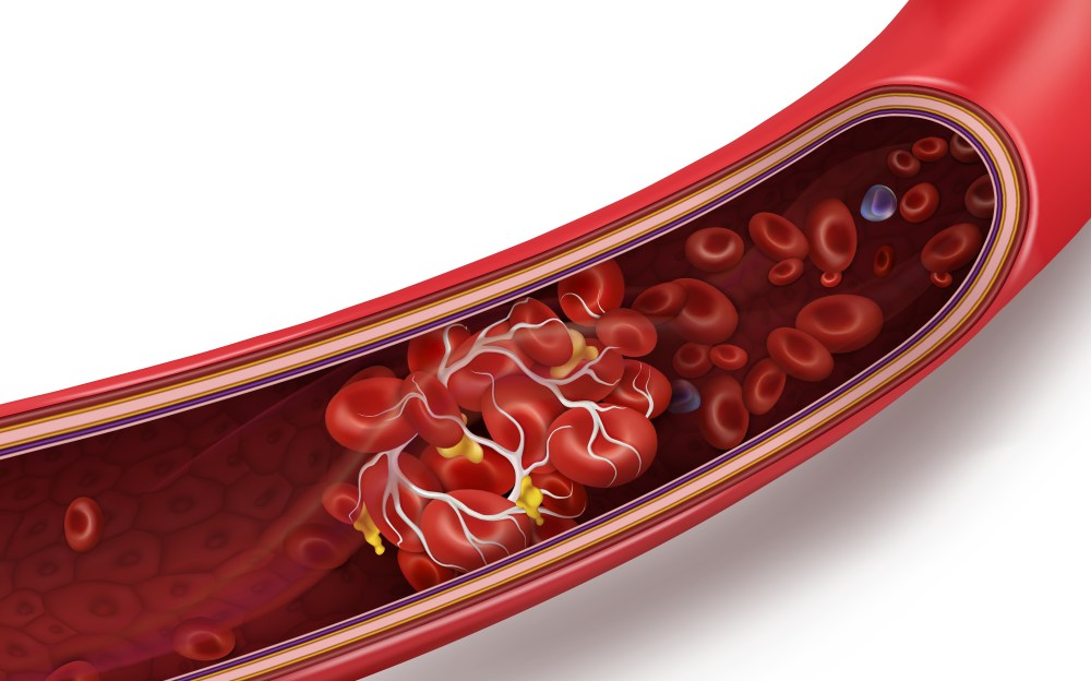 Top 6 Natural Blood Thinners
