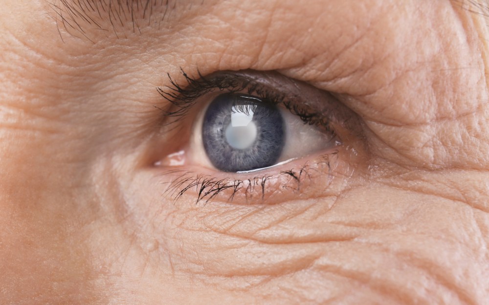 Natural Remedies for Cataracts
