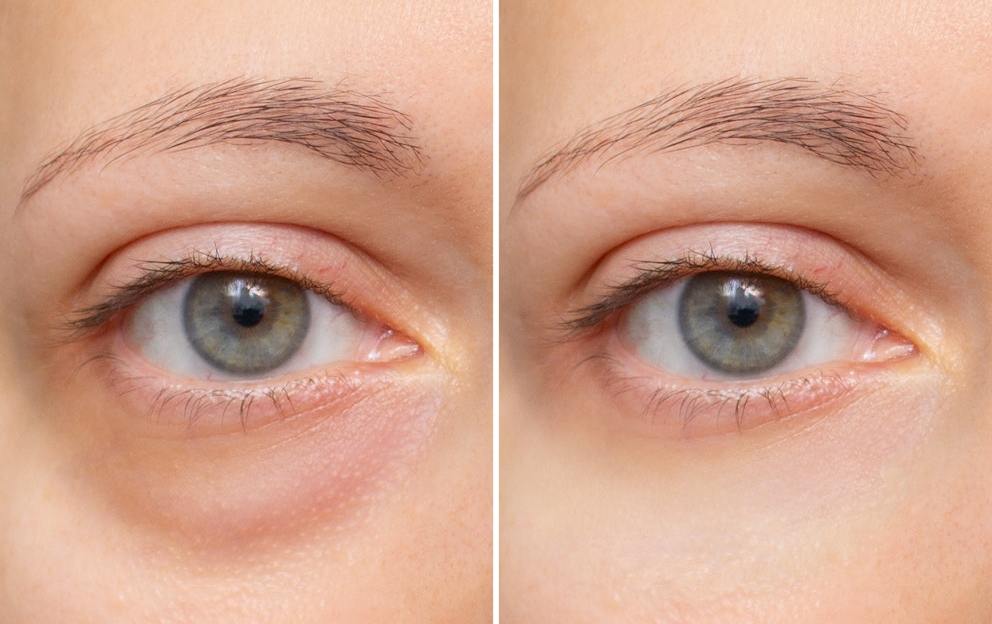 Dark Circles Under Eyes: Causes and Natural Remedies
