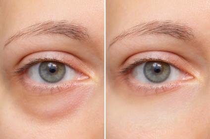 Dark Circles Under Eyes: Causes and Natural Remedies