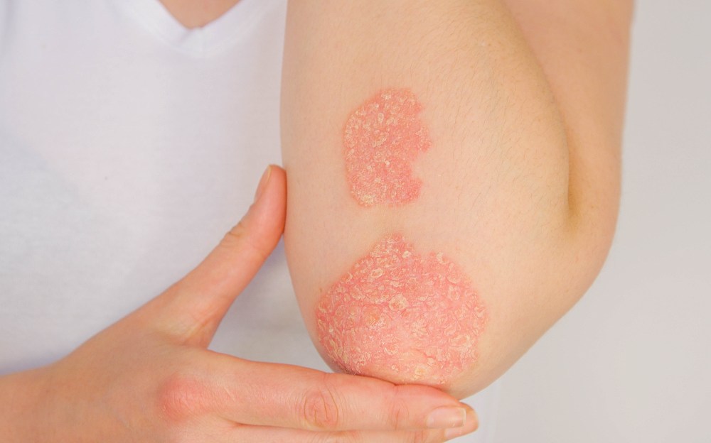 Psoriasis Relief: Everyday Habits for Healthier Skin