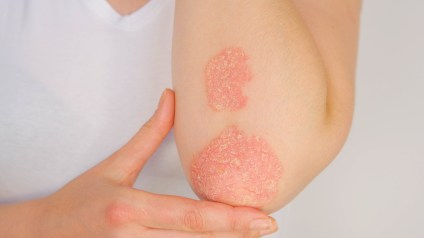 Psoriasis Relief: Everyday Habits for Healthier Skin