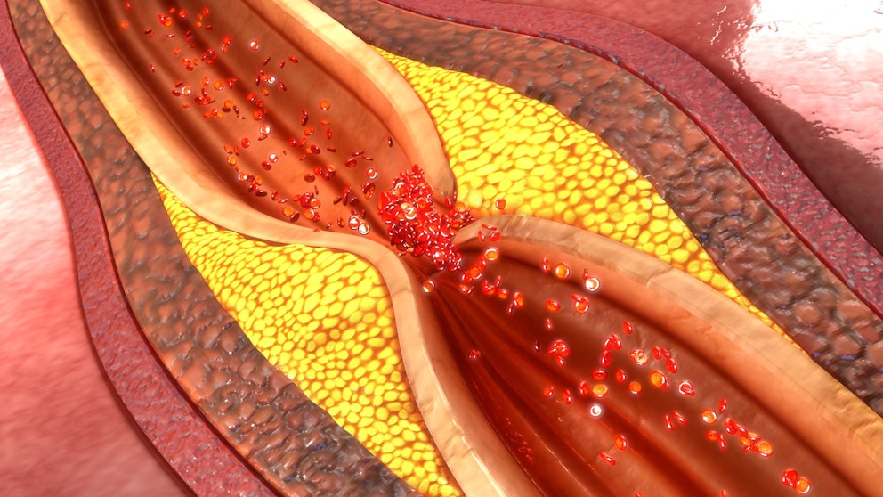 How to Clean Your Arteries &ndash; Naturally Prevent Blockage