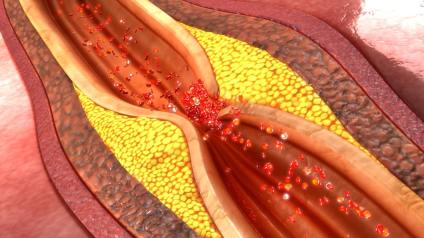 How to Clean Your Arteries &ndash; Naturally Prevent Blockage