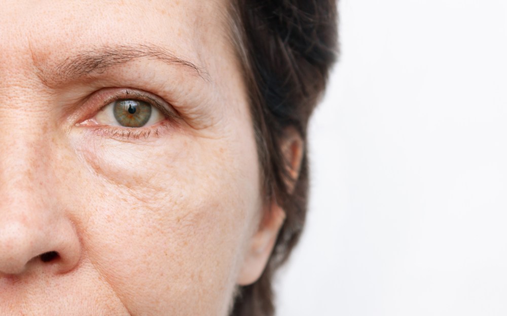 What Causes Puffy Eyes?