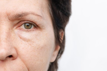 What Causes Puffy Eyes?