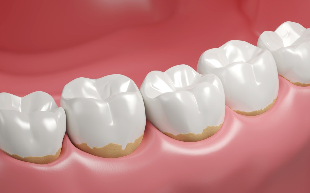 5 Natural Ways to Remove Dental Plaque