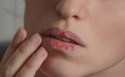 Discolored or Dry Lips Can Indicate Vitamin Deficiency