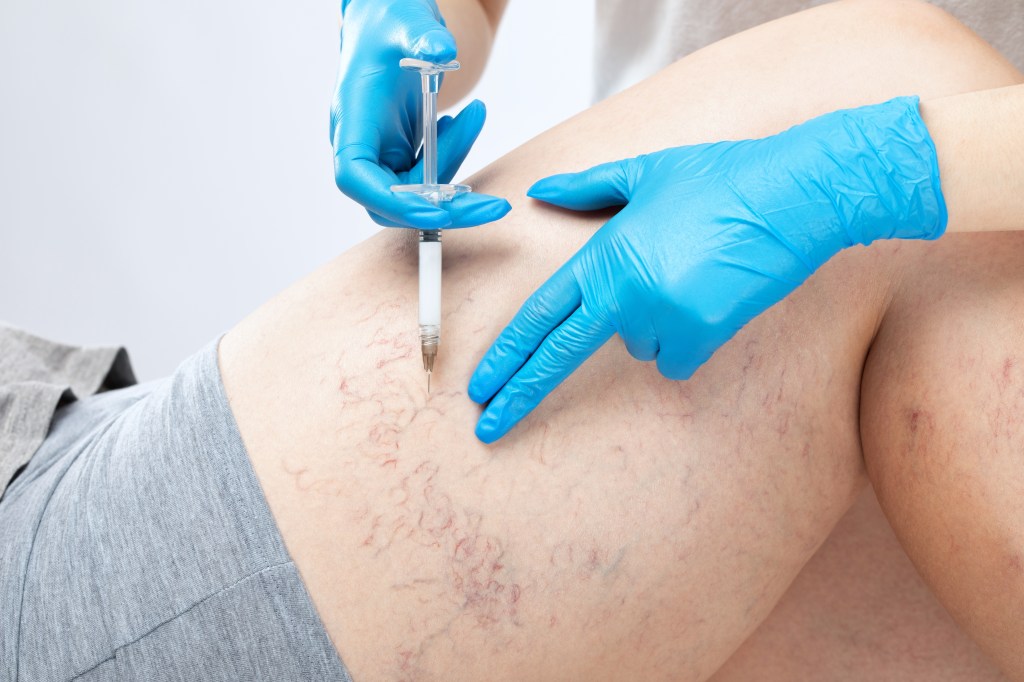Medical treatment for spider veins