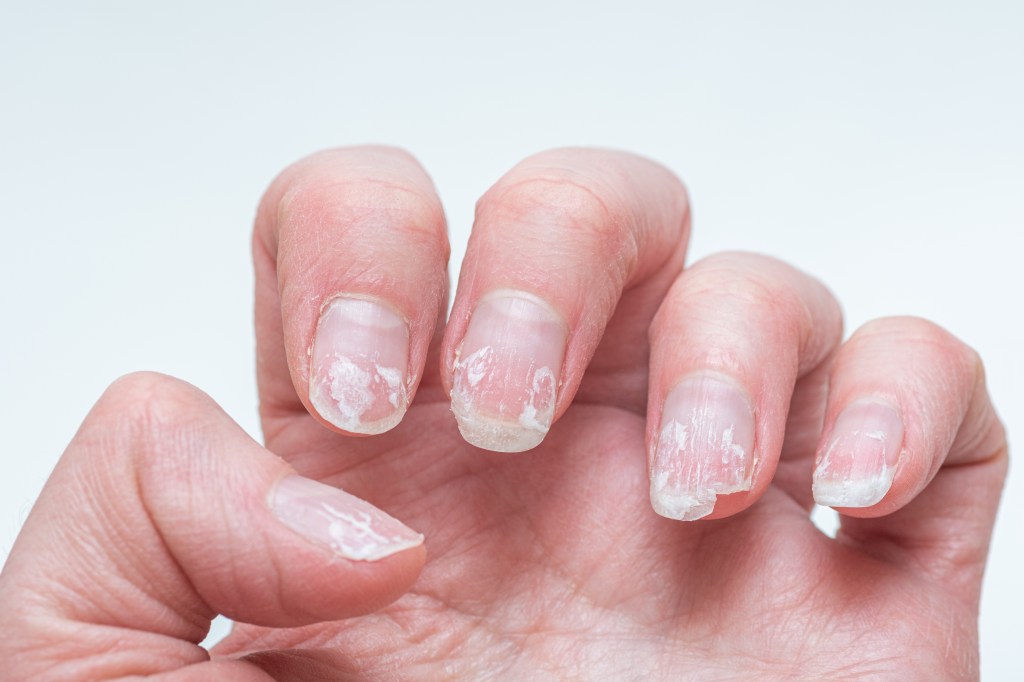 Brittle nails