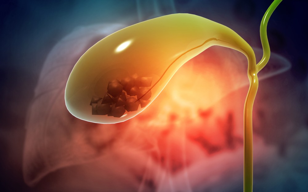 What Dissolves Gallbladder Stones Fast?