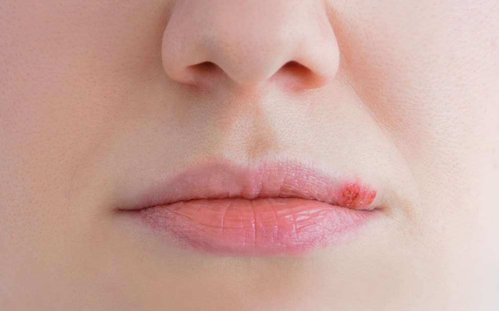 Best Diet for Herpes: What to Eat and Avoid to Reduce Outbreaks