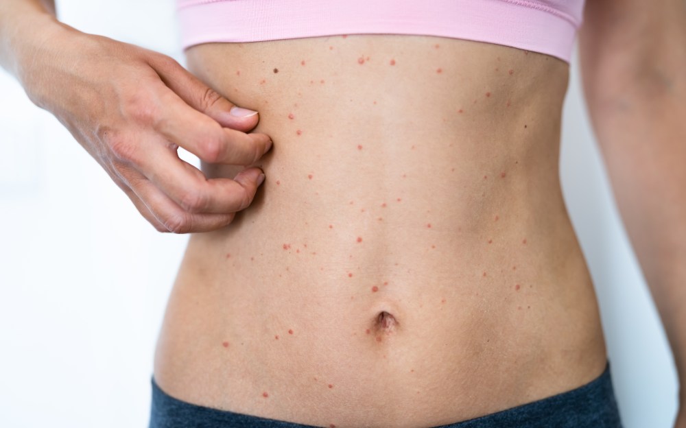 What Is Keto Rash?