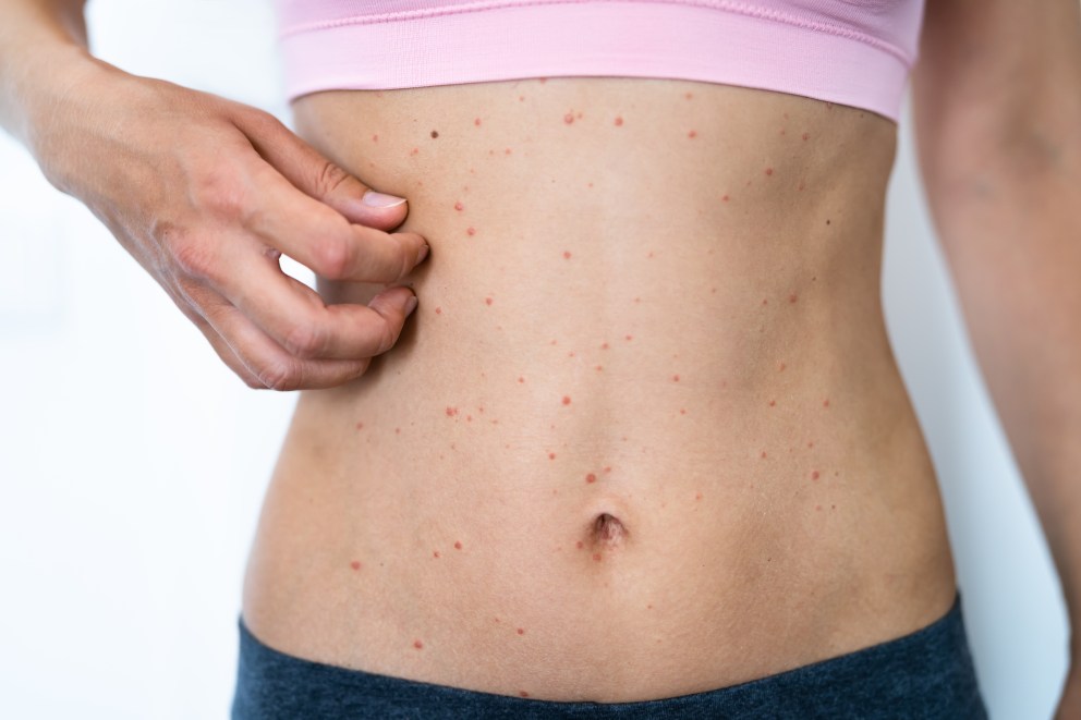 What Is Keto Rash?