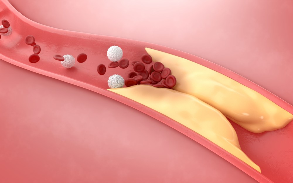 Best Nutrients to Remove Plaque from Arteries