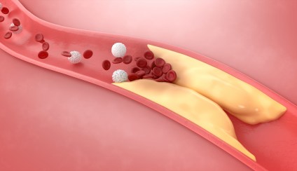 Best Nutrients to Remove Plaque from Arteries