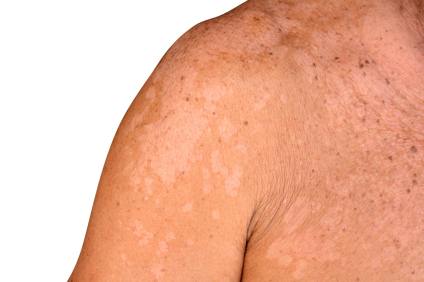 Tinea Versicolor Natural Remedies