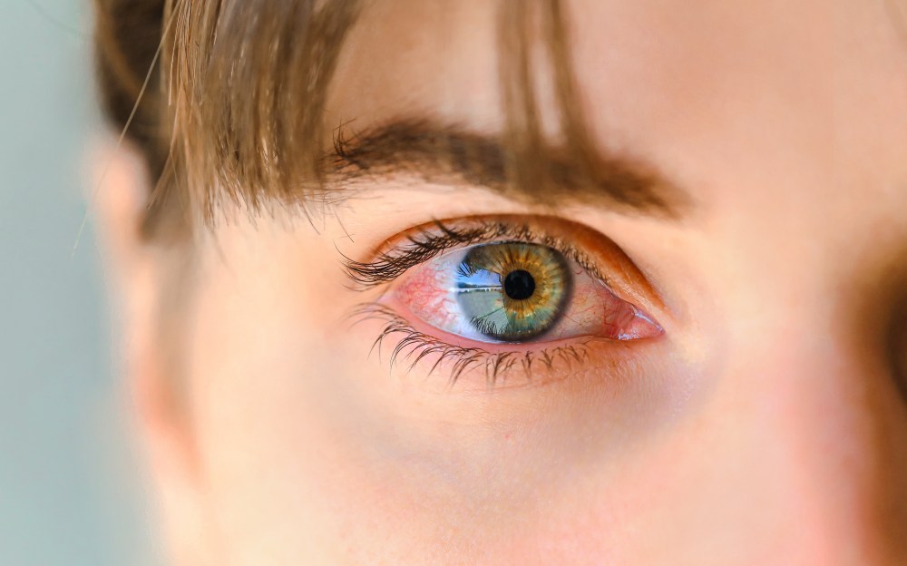 Red Eyes? You Might Have a Vitamin Deficiency