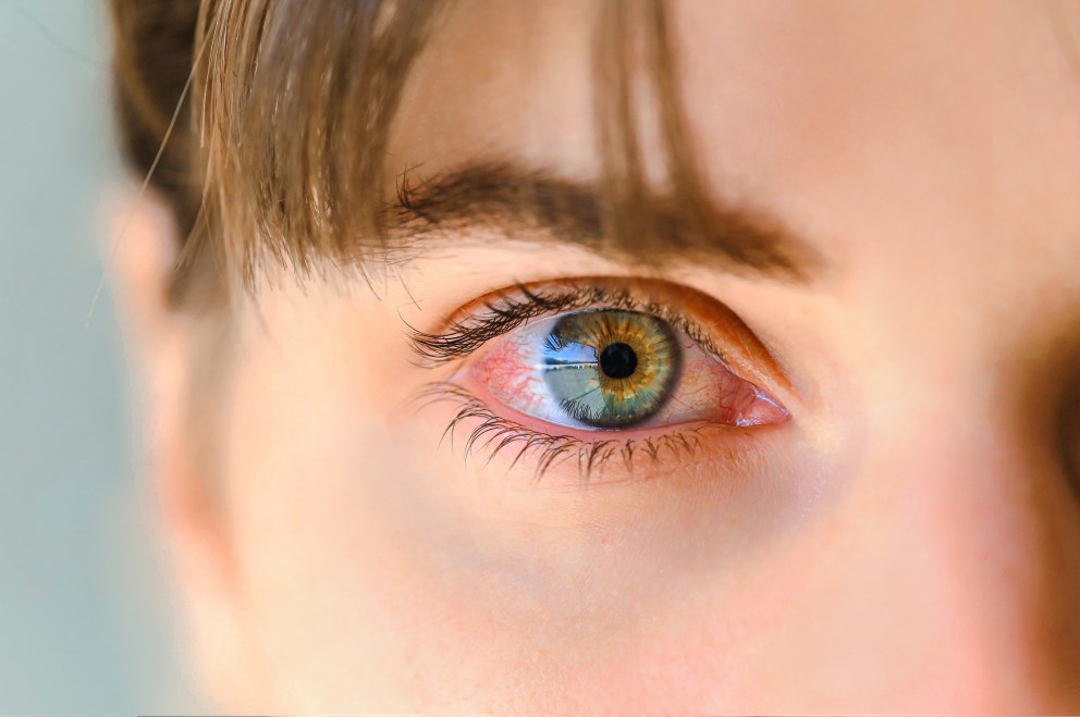 Red Eyes? You Might Have a Vitamin Deficiency
