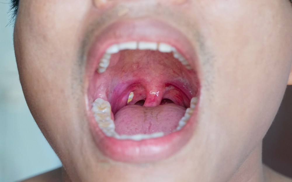 How to Help Prevent Tonsil Stones: Tips for a Healthy Mouth