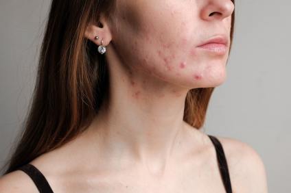 Hormonal Acne Diet Tips, Causes, and Remedies