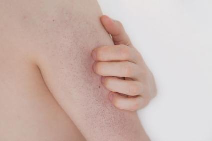 The Best Natural Remedies for Keratosis Pilaris